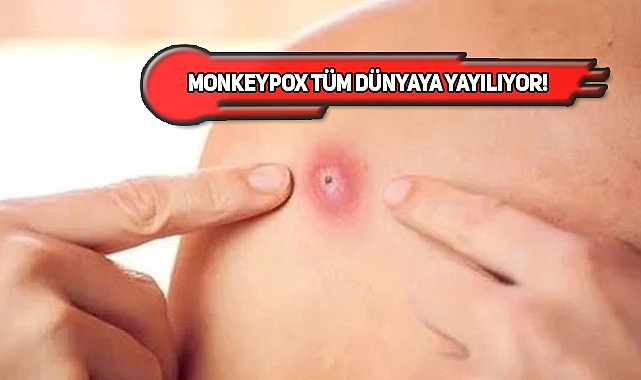 Monkeypox, Türklerin Yoğun Olduğu Şehirde