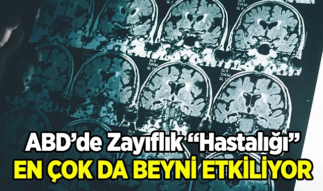 Zayıflık En Çok Da Beyni Etkiliyor!