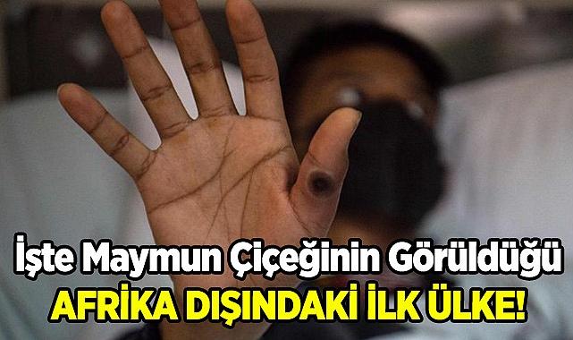 Maymun Çiçeği Yayılıyor! İşte Görüldüğü Afrika Dışı İlk Ülke