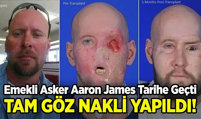 Emekli Asker Aaron James Tarihe Geçti: Dünyadaki İlk Tam Göz Nakli!